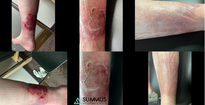 summus